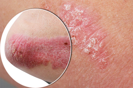 Psoriasis Treatment in Pune