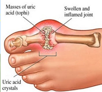 Arthritis Treatment in Pune
