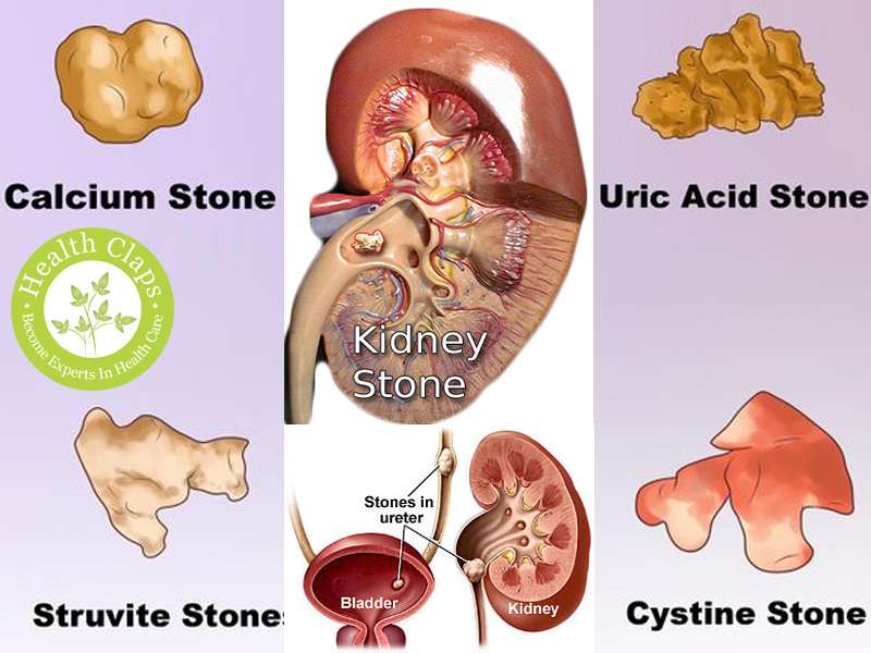 Kidney Stone Treatment in Pune