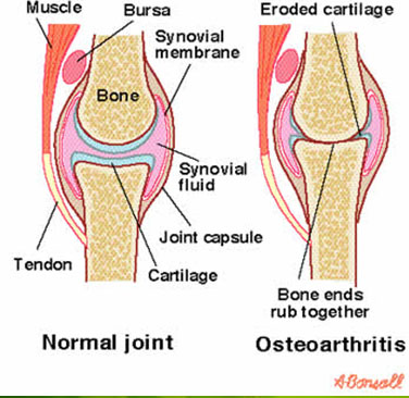 Arthritis Treatment in Pune
