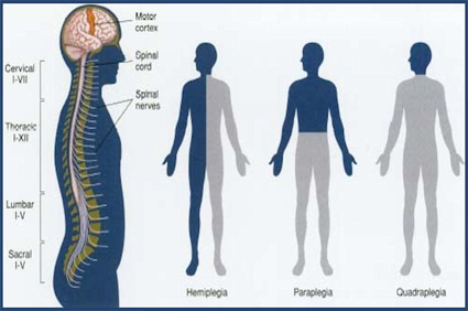 Paralysis Treatment in Pune