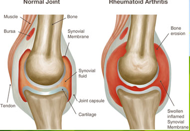 Arthritis Treatment in Pune
