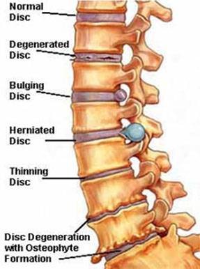 Spondylosis Treatment in Pune